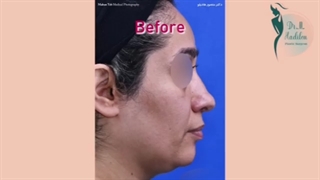 نمونه جراحی رینوپلاستی بلافاصله پس از عمل