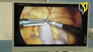 فیلم واقعی تجمع چربی دور روده در اتاق عمل
