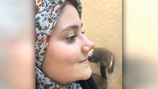 عمل بینی طبیعی | دکتر گلی