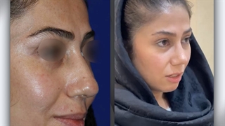 رضایت بیمار عزیز 6 ماه پس از عمل بینی | دکتر گلی