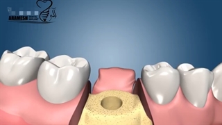 مرکز تخصصی ایمپلنت