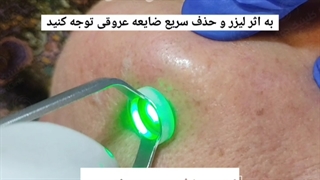 لیزر حذف عروق واریسی