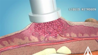 زگیل چیست و روش های از بین بردن آن چیست؟