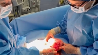 فیلم جراحی فیبروم 15 سانتی متری