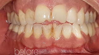 ایمپلنت و لمینت