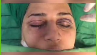 جراحی پلک یا بلفاروپلاستی – هزینه و توصیه ها