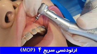 ارتودنسی سریع 4 (MOP) | دکتر احسان ابوئی مهریزی