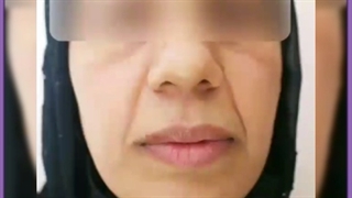 جوانسازی پوست صورت با لیزر آر اف فرکشنال آر اف فرکشنال