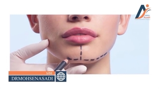 سوالات متداول زاویه سازی صورت | دکتر محسن اسدی