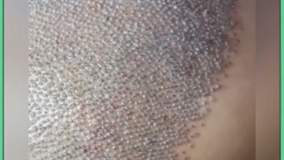 کاشت مو به روش BHT
