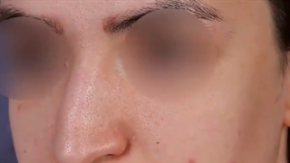 بلافاصله بعد از جراحی بینی