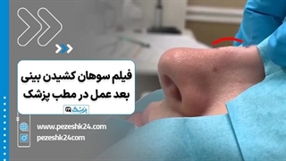 فیلم سوهان کشیدن بعد عمل بینی در مطب پزشک