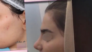 قبل و بعد جراحی بینی زیباجوی عزیزمون