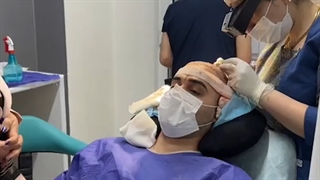 فیلم واقعی عمل کاشت مو در تهران