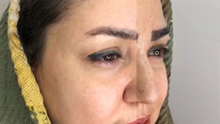 نمونه ای از عمل کاشت ابرو کلینیک گلبان