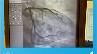 عمل جراحی قلب باز