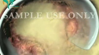 تعویض مفصل لگن