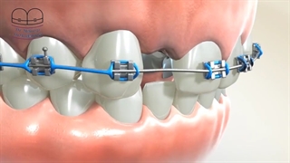 ارتودنسی و کمبود دندان | دکتر احسان ابوئی مهریزی