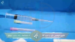 لاغری موضعی بازو با دستگاه Endo-RF Subcision