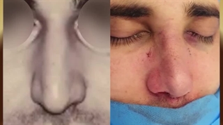 قبل و بعد عمل زیبایی بینی مردانه