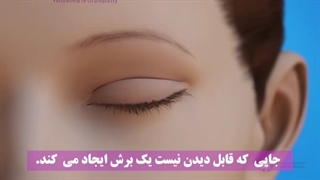 جراحی افتادگی پلک ( پتوز )