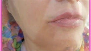 تزریق ژل خط خنده | بهترین برندها، مزایا، ماندگاری و هزینه