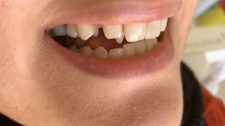 کامپوزیت دندان