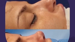 نمونه ای از جراحی بینی در اتاق عمل