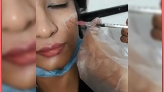 راهکارهای قطعی از بین بردن خط خنده با تزریق ژل