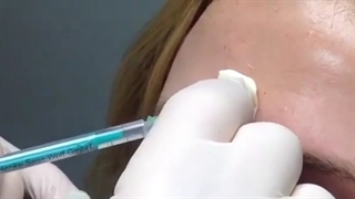 تزریق بوتاکس جراحی لثه