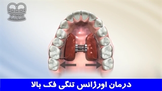 درمان اورژانس تنگی فک بالا | دکتر احسان ابوئی مهریزی
