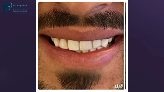 اصلاح طرح لبخند