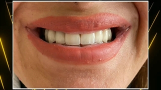 اصلاح طرح لبخند