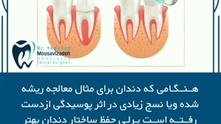 تفاوت لمینت و روکش دندان