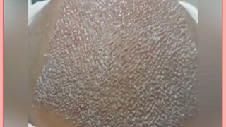 کاشت مو به روش SUT | هزینه، مزایا ، مراحل و عوارض احتمالی