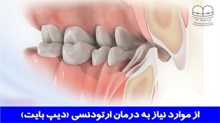 از موارد نیاز به درمان ارتودنسی (دیپ بایت) | دکتر احسان ابوئی مهریزی