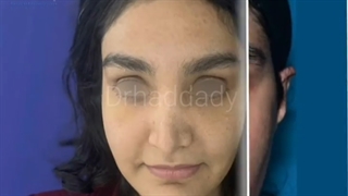 لیفت اندوسکوپیک پیشانی یکهفته بعد عمل (بدون کبودی)