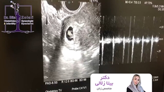 تعیین جنسیت صد در صدی در هفته هفتم