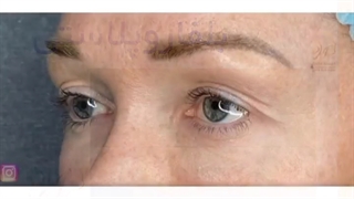 فیلم واقعی جراحی زیبایی پلک برداشتن پوست های اضافی و افتاده