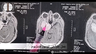 عمل جراحی تومور مننژیوم