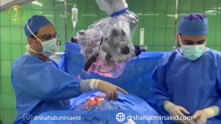 جراحی میکروسکوپی تومور بسیار بزرگ نخاع تورایسک