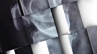 تعویض مفصل زانو