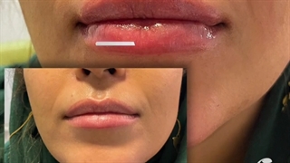 تزریق ژل لب و چانه پیلینگ