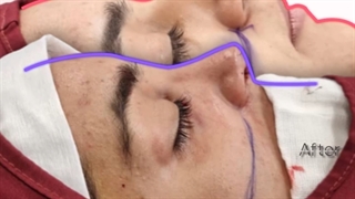 فیلم اتاق عمل بینی استخوانی