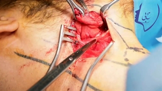 جراحی توده گردنی