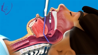 جراحی سنگ لوزه