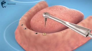 ایمپلنت دندان