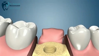 ایمپلنت دندان