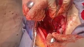 فیلم خارج سازی تومور از مهره