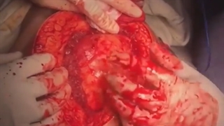 جراحی تومور لگن